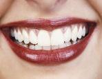 Tooth Whitening